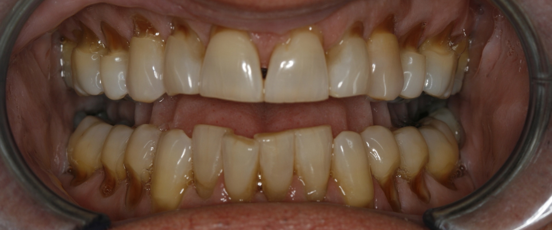 Can cosmetic dentistry fix receding gums?