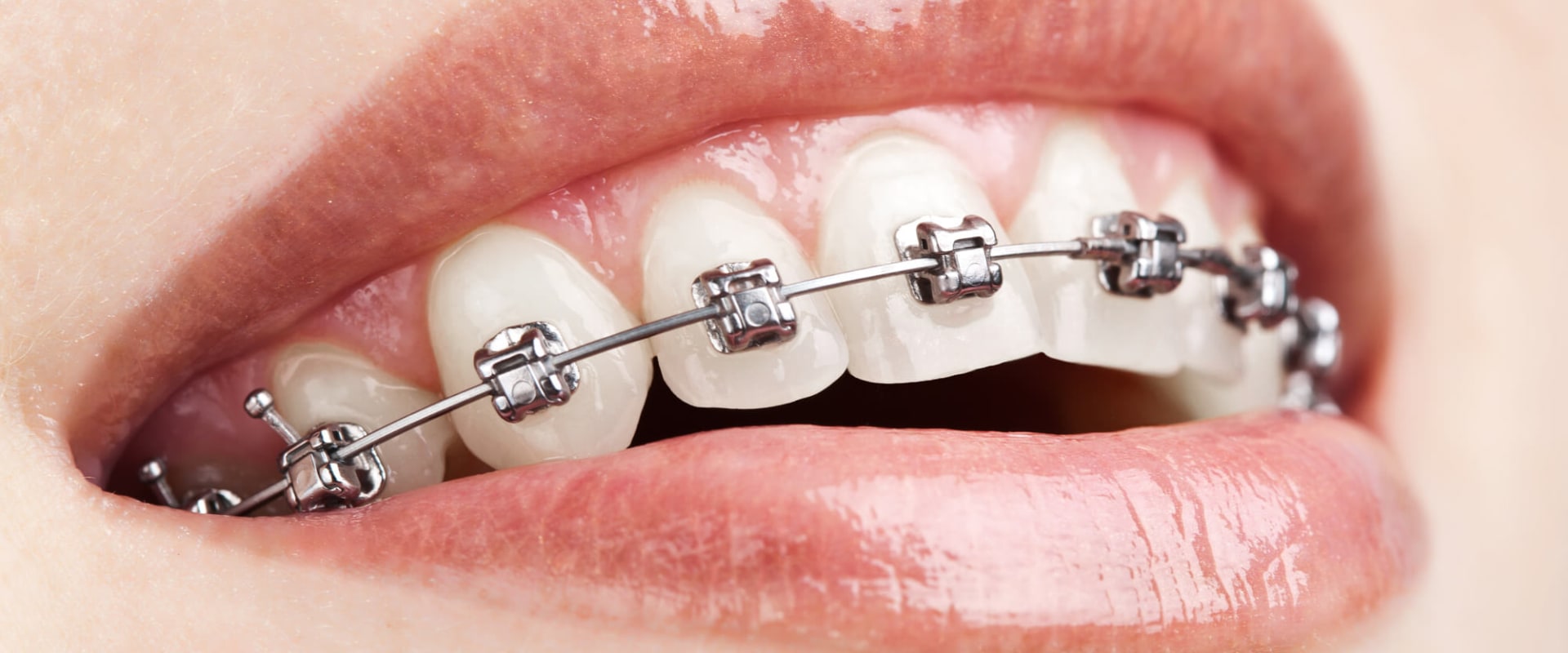 Are cosmetic braces safe?