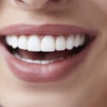 Get That Perfect Smile With Cosmetic Dentistry In Waco: What You Should Know