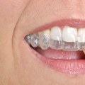 Invisalign In Spring, TX: Your Guide To Straightening Your Teeth With Cosmetic Dentistry