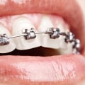 Are cosmetic braces safe?