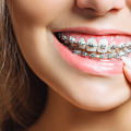 Are braces cosmetic or necessary?