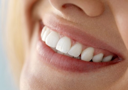 Cosmetic Dentistry: What You Need To Know About Porcelain Veneers In Beverly Hills, CA