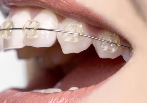 Cosmetic Dentistry In Cedar Park: Enhance Your Smile With Dental Implants
