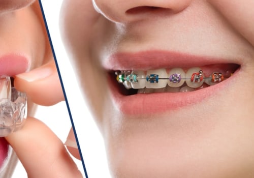 What is the difference between cosmetic braces and authentic braces?